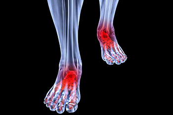 Arthritic foot and ankle care treatment, foot arthritis treatment in the San Juan, 00924, Puerto Rico area