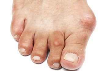 Bunions treatment in the San Juan, 00924, Puerto Rico area