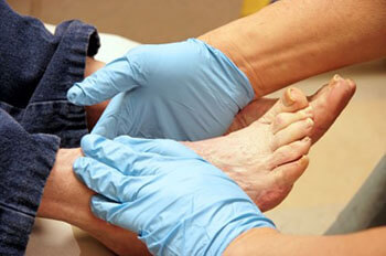 Diabetic foot treatment and care, Diabetic Ulcers Treatment & Management in the San Juan, 00924, Puerto Rico area