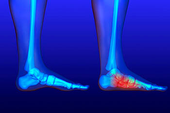 Flat feet and Fallen Arches treatment, Flatfoot Deformity Treatment in the San Juan, 00924, Puerto Rico area