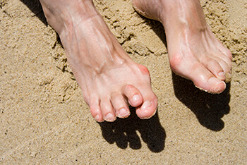 Hammertoes & Mallet Toes treatment in the San Juan, 00924, Puerto Rico area