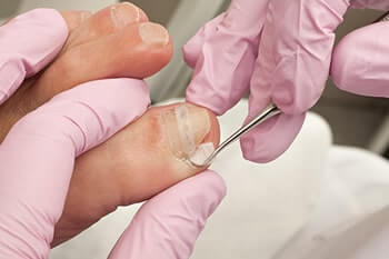 Ingrown toenails treatment in the San Juan, 00924, Puerto Rico area