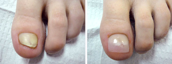 keryflex nail restoration