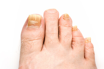 Fungal toenails, toenail fungus diagnosis and treatment in the San Juan, 00924, Puerto Rico area