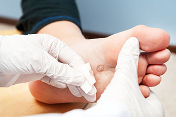 Plantar warts treatment in the San Juan, 00924, Puerto Rico area